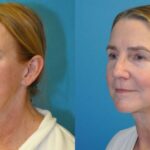 Face and Neck Lift #9 - Before and After