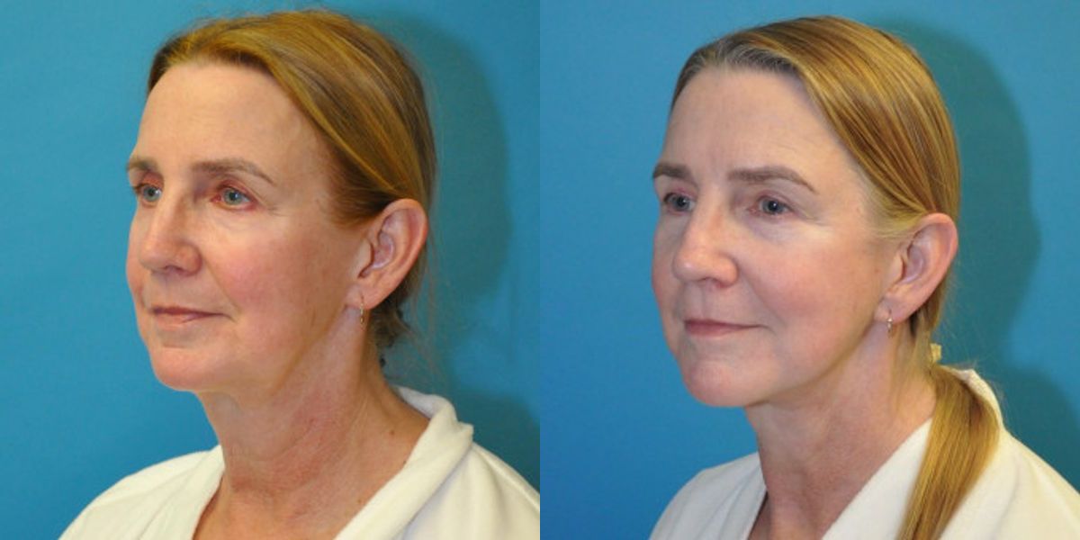Face and Neck Lift #9 - Before and After