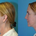 Face and Neck Lift #9 - Before and After