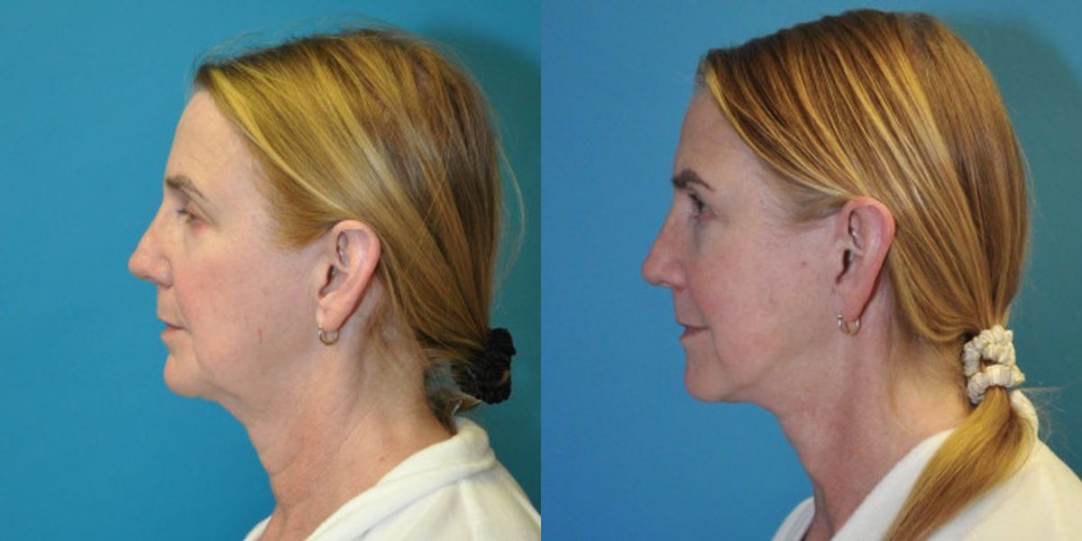 Face and Neck Lift #9 - Before and After