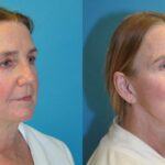 Face and Neck Lift #9 - Before and After