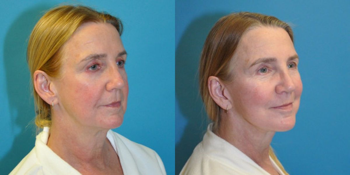Face and Neck Lift #9 - Before and After