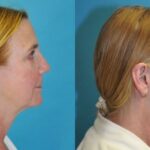 Face and Neck Lift #9 - Before and After