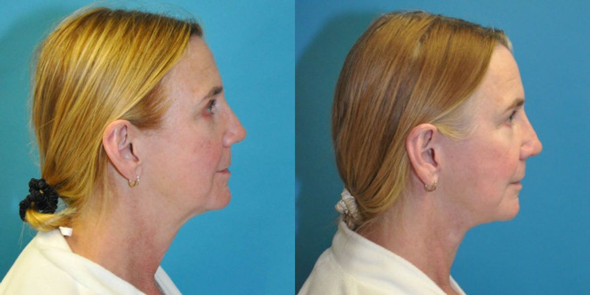 Face and Neck Lift #9 - Before and After