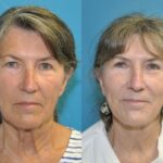 Face and Neck Lift and Upper Eyelid Lift #6 - Before and After