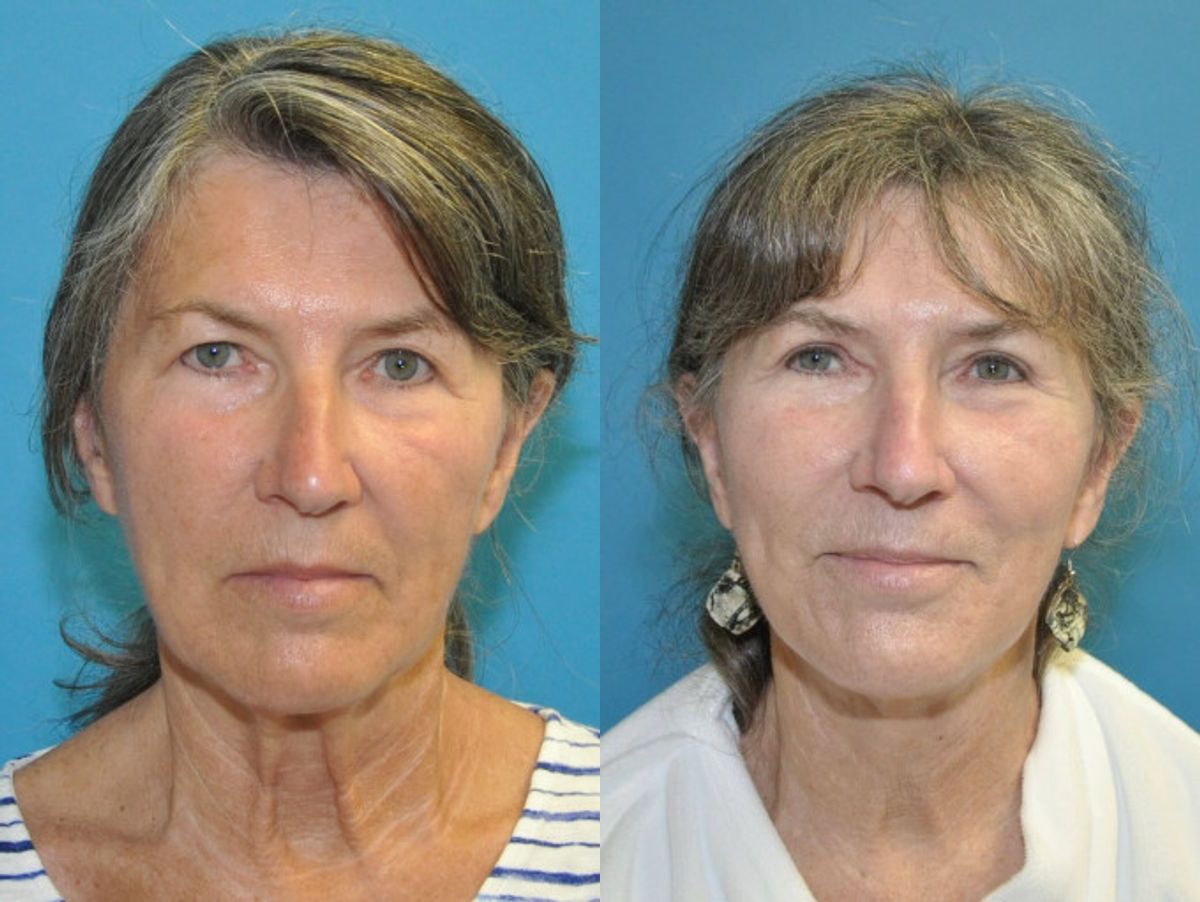 Face and Neck Lift and Upper Eyelid Lift #6 - Before and After