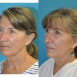 Face and Neck Lift and Upper Eyelid Lift #6 - Before and After