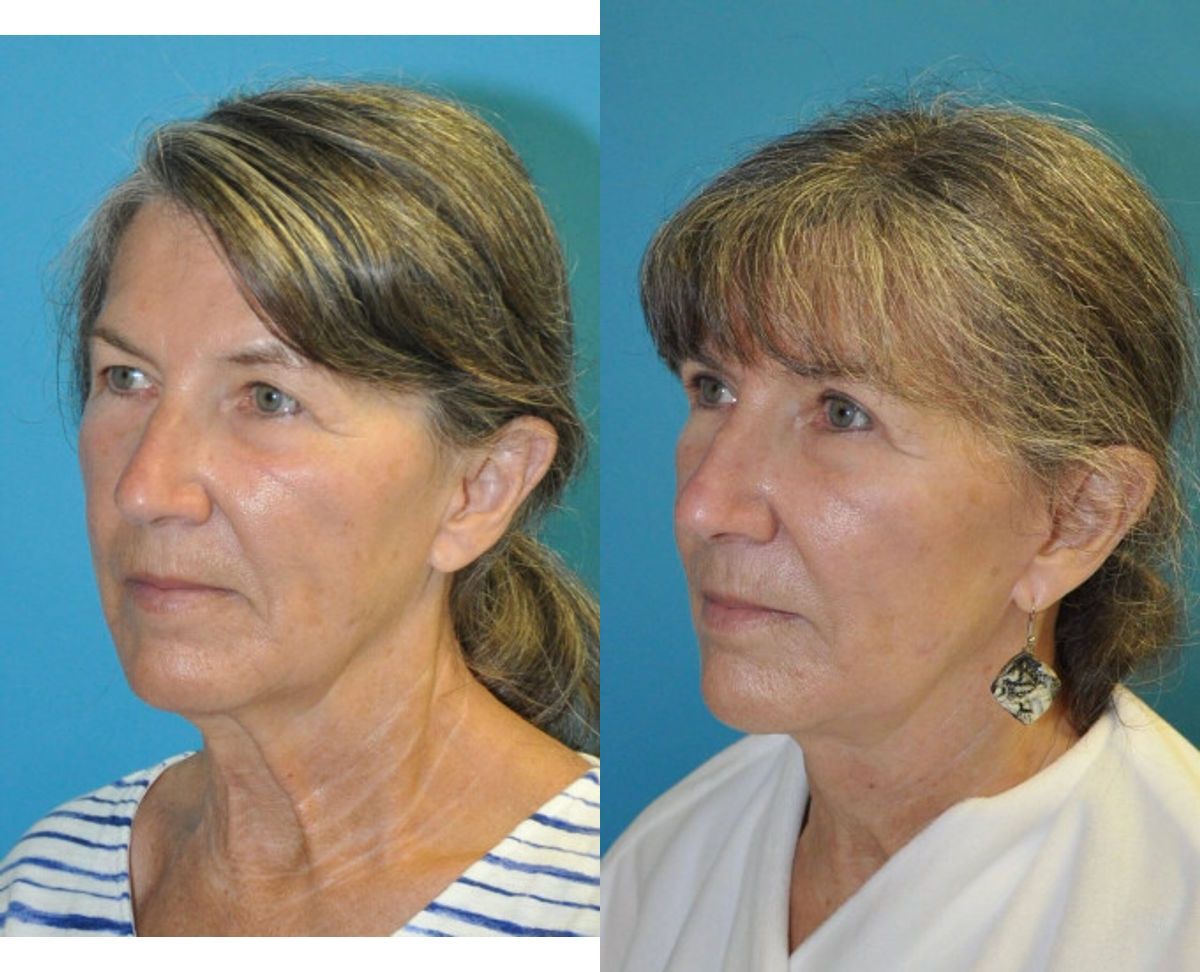 Face and Neck Lift and Upper Eyelid Lift #6 - Before and After