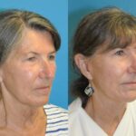 Face and Neck Lift and Upper Eyelid Lift #6 - Before and After