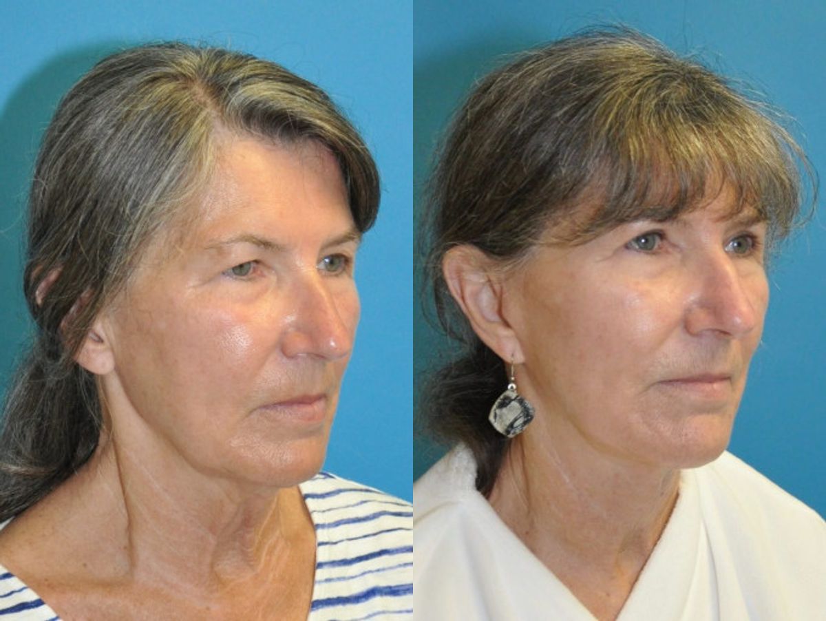 Face and Neck Lift and Upper Eyelid Lift #6 - Before and After