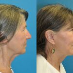 Face and Neck Lift and Upper Eyelid Lift #6 - Before and After