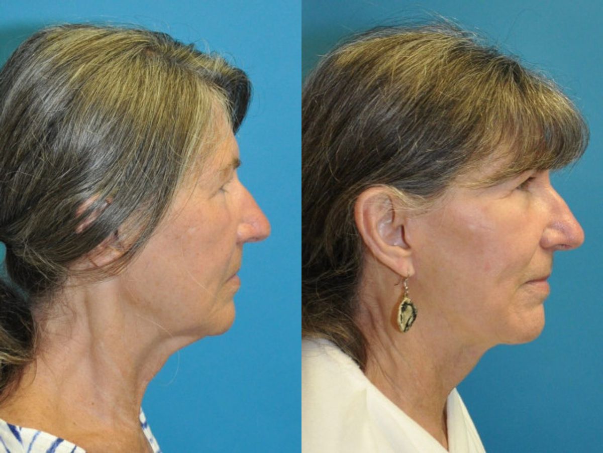 Face and Neck Lift and Upper Eyelid Lift #6 - Before and After
