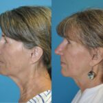 Face and Neck Lift and Upper Eyelid Lift #6 - Before and After