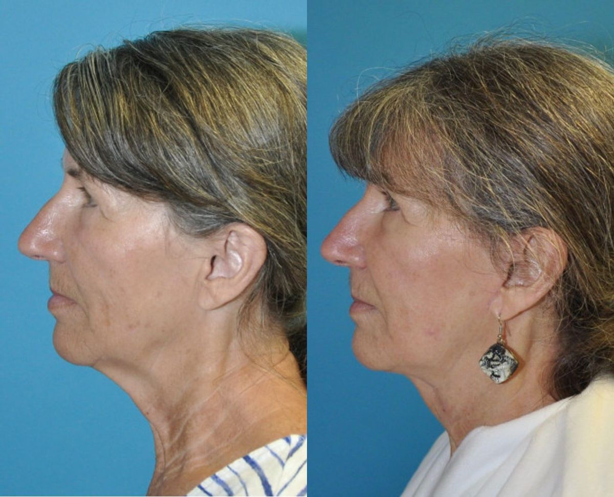Face and Neck Lift and Upper Eyelid Lift #6 - Before and After