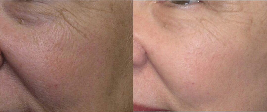 Fat Grafting to Face #1