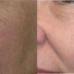 Fat Grafting to Face #1 - Before and After