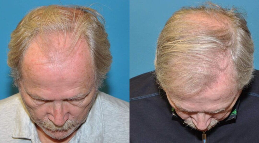 FUE NeoGraft Hair Transplant #1