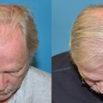 FUE NeoGraft Hair Transplant #1 - Before and After