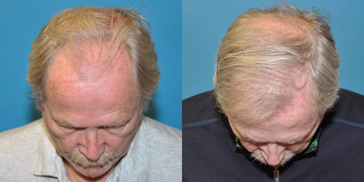 FUE NeoGraft Hair Transplant #1 - Before and After