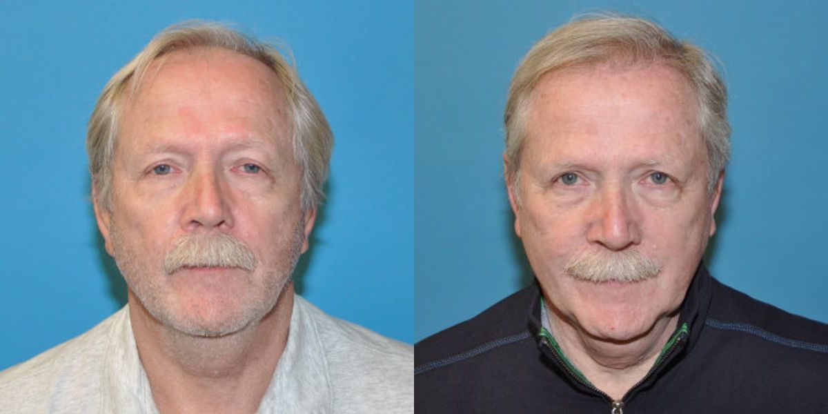 FUE NeoGraft Hair Transplant #1 - Before and After