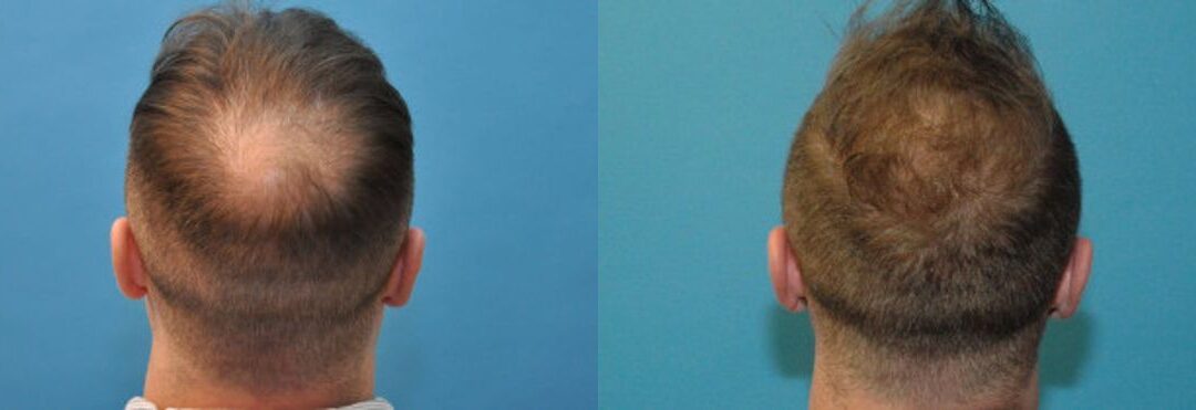 FUE NeoGraft Hair Transplant #2