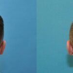 FUE NeoGraft Hair Transplant #2 - Before and After