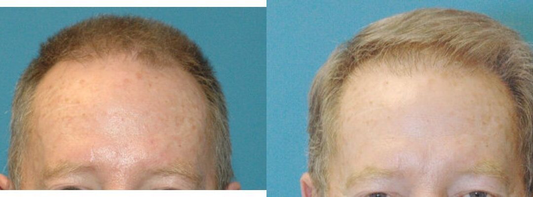 FUE NeoGraft Hair Transplant #3