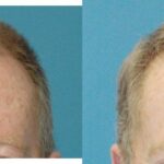 FUE NeoGraft Hair Transplant #3 - Before and After