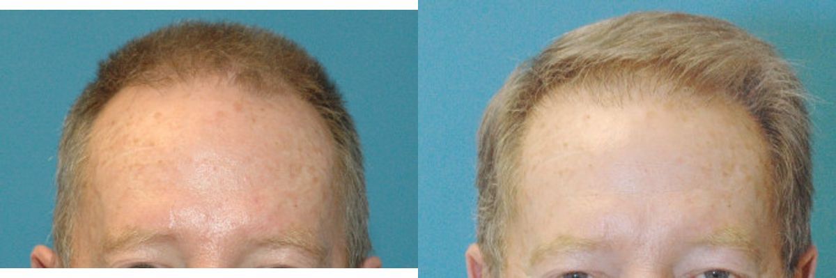 FUE NeoGraft Hair Transplant #3 - Before and After