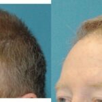 FUE NeoGraft Hair Transplant #3 - Before and After