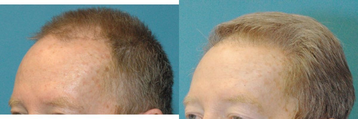 FUE NeoGraft Hair Transplant #3 - Before and After