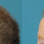FUE NeoGraft Hair Transplant #3 - Before and After