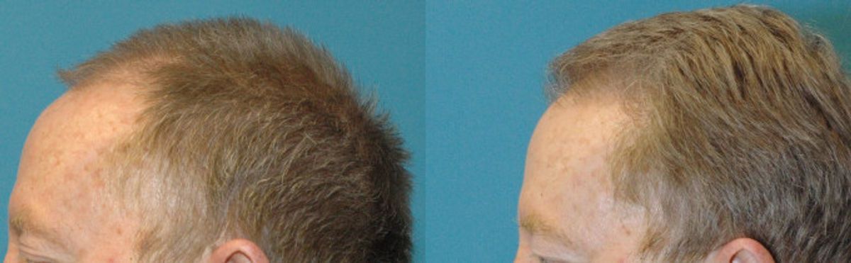 FUE NeoGraft Hair Transplant #3 - Before and After