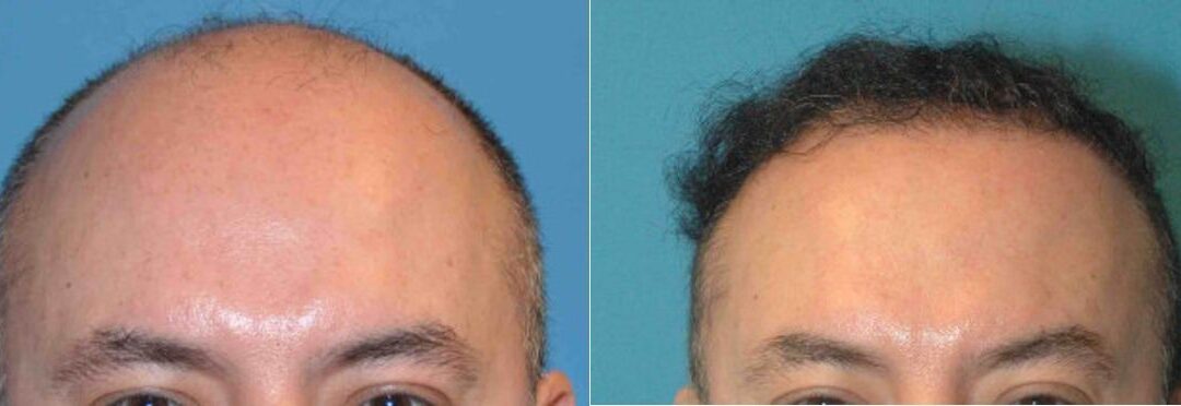 FUE NeoGraft Hair Transplant #4