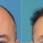 FUE NeoGraft Hair Transplant #4 - Before and After