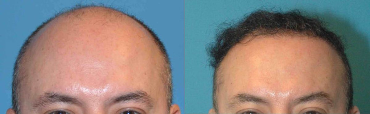 FUE NeoGraft Hair Transplant #4 - Before and After