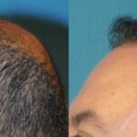 FUE NeoGraft Hair Transplant #4 - Before and After