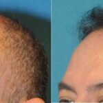 FUE NeoGraft Hair Transplant #4 - Before and After