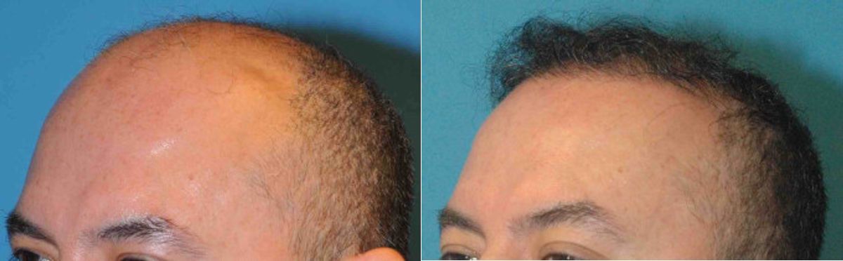 FUE NeoGraft Hair Transplant #4 - Before and After