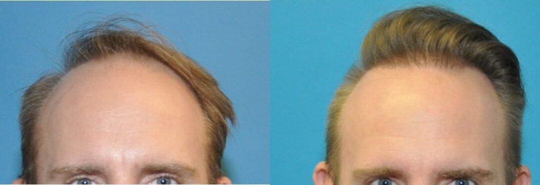 FUE NeoGraft Hair Transplant #10