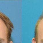 FUE NeoGraft Hair Transplant #10 - Before and After