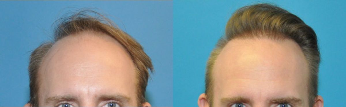 FUE NeoGraft Hair Transplant #10 - Before and After