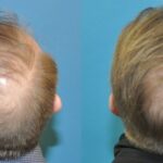 FUE NeoGraft Hair Transplant #10 - Before and After