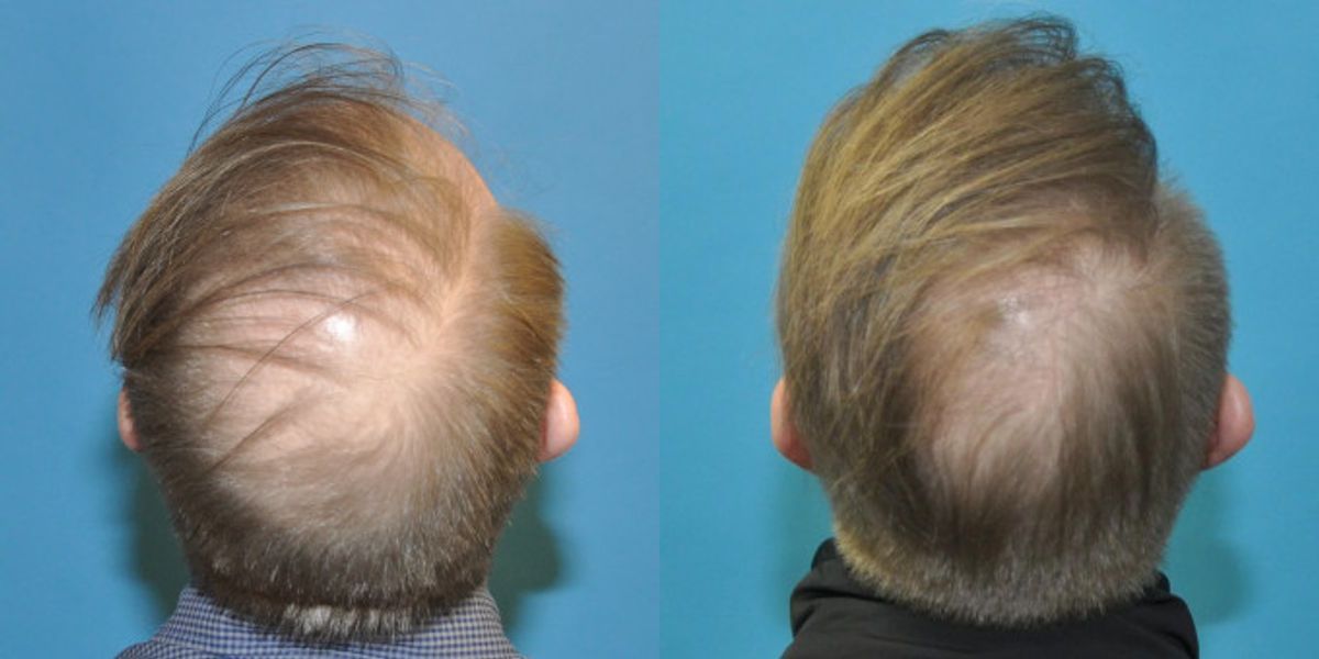 FUE NeoGraft Hair Transplant #10 - Before and After