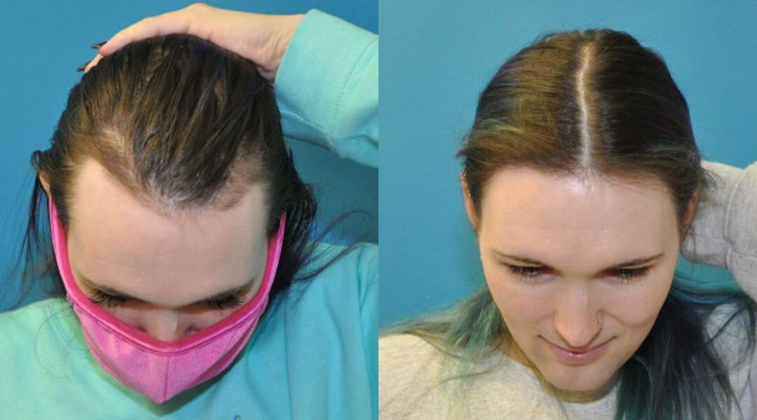 FUE NeoGraft Hair Transplant #11