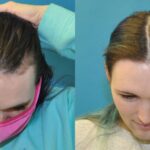FUE NeoGraft Hair Transplant #11 - Before and After