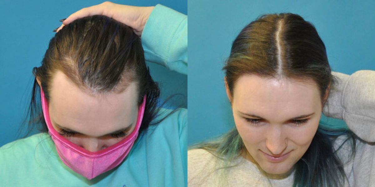 FUE NeoGraft Hair Transplant #11 - Before and After