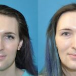 FUE NeoGraft Hair Transplant #11 - Before and After