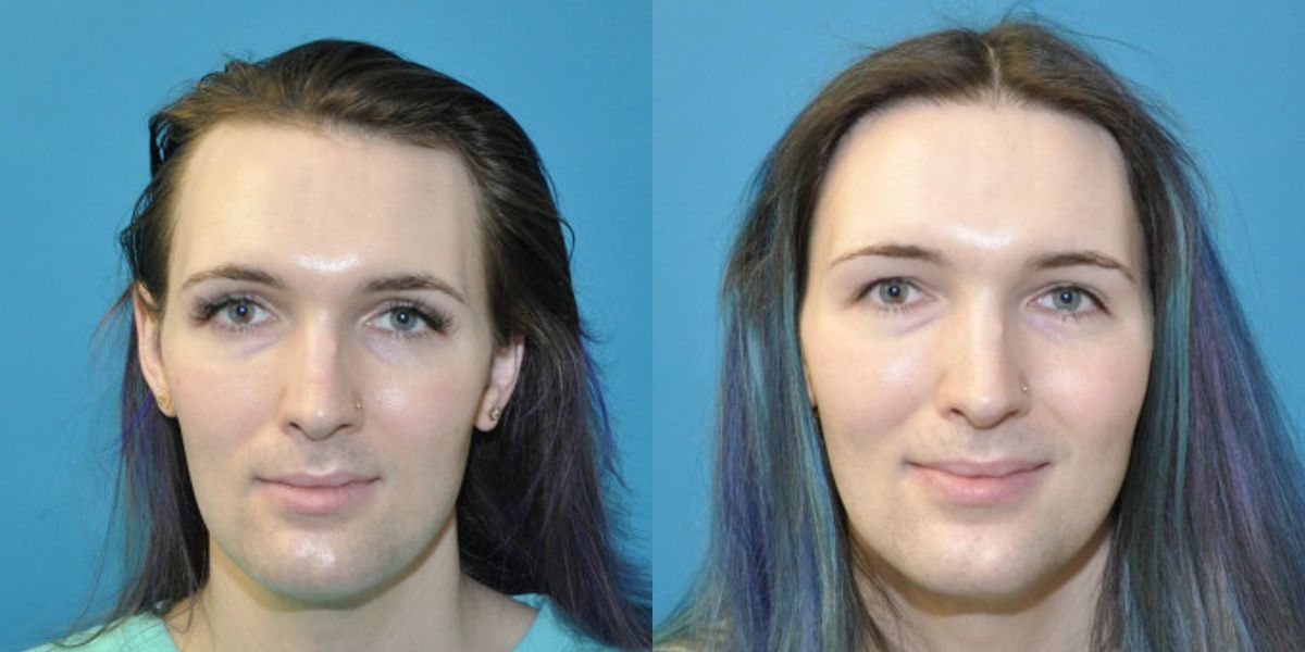 FUE NeoGraft Hair Transplant #11 - Before and After