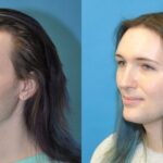 FUE NeoGraft Hair Transplant #11 - Before and After